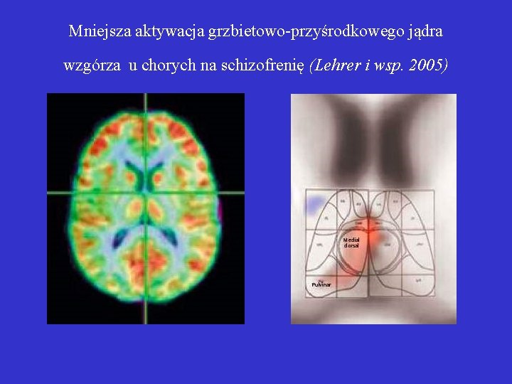 Mniejsza aktywacja grzbietowo-przyśrodkowego jądra wzgórza u chorych na schizofrenię (Lehrer i wsp. 2005) 
