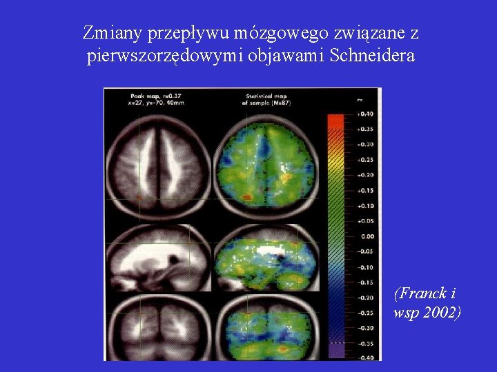Zmiany przepływu mózgowego związane z pierwszorzędowymi objawami Schneidera (Franck i wsp 2002) 