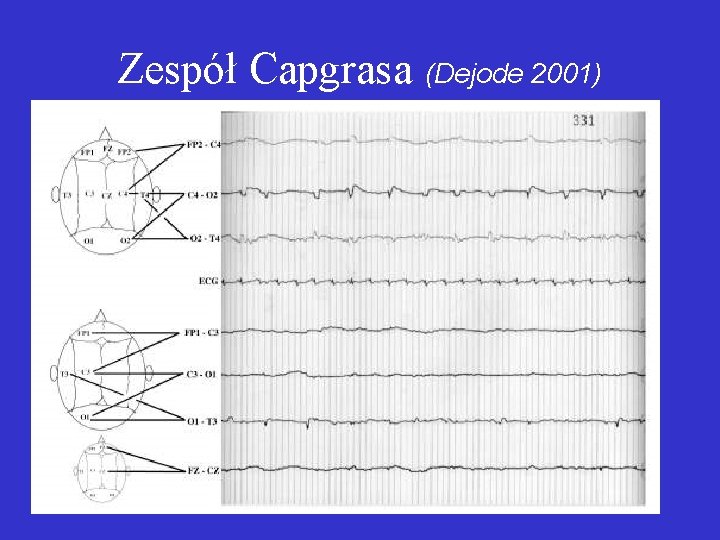 Zespół Capgrasa (Dejode 2001) 