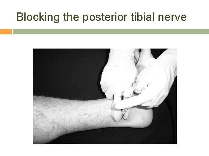Blocking the posterior tibial nerve 