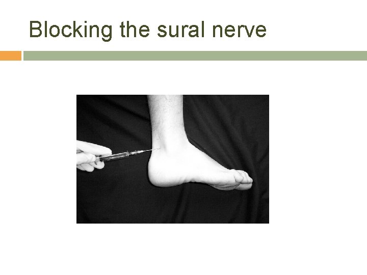 Blocking the sural nerve 