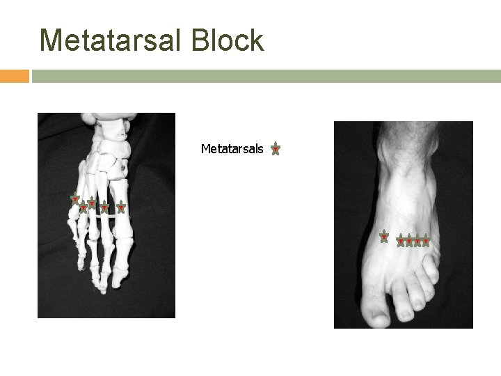 Metatarsal Block Metatarsals 