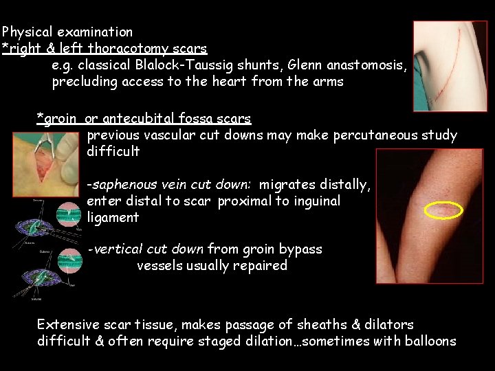 Physical examination *right & left thoracotomy scars e. g. classical Blalock-Taussig shunts, Glenn anastomosis,