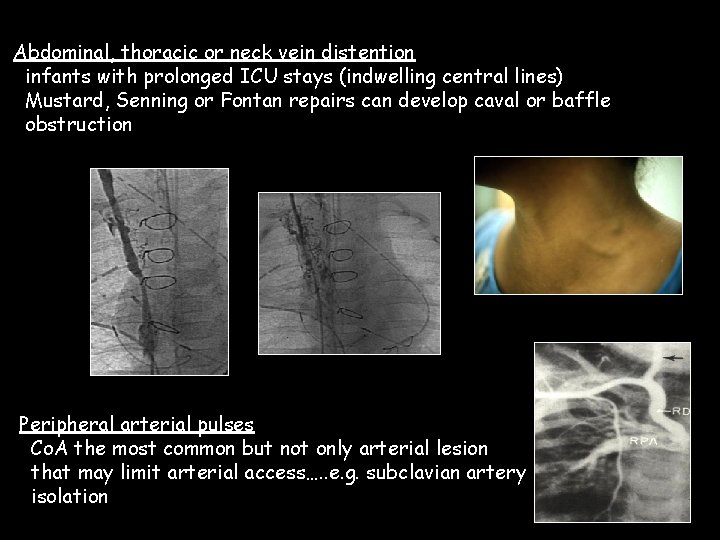 Abdominal, thoracic or neck vein distention infants with prolonged ICU stays (indwelling central lines)