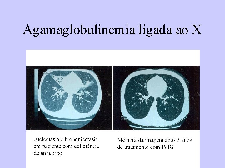 Agamaglobulinemia ligada ao X 