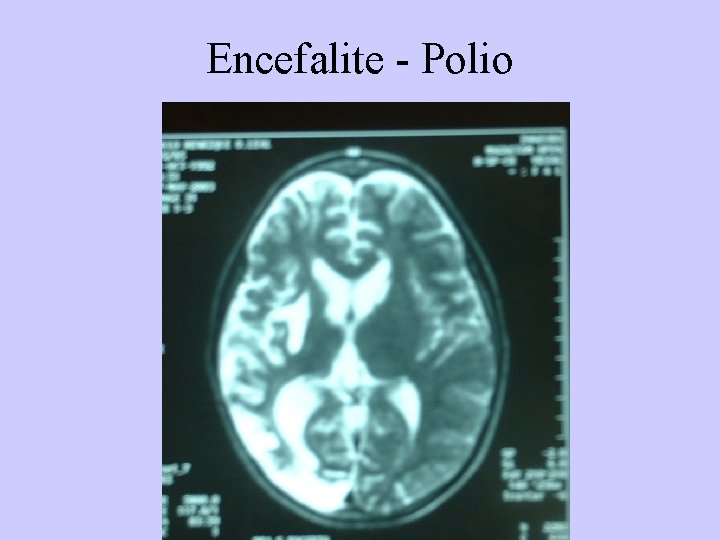 Encefalite - Polio 