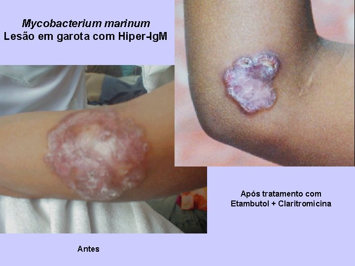 Mycobacterium marinum Lesão em garota com Hiper-Ig. M Após tratamento com Etambutol + Claritromicina