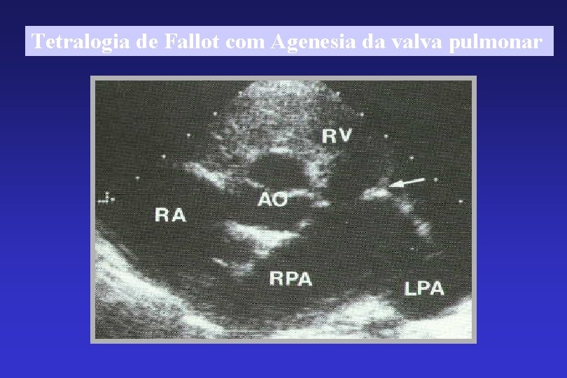 Tetralogia de Fallot com Agenesia da valva pulmonar 