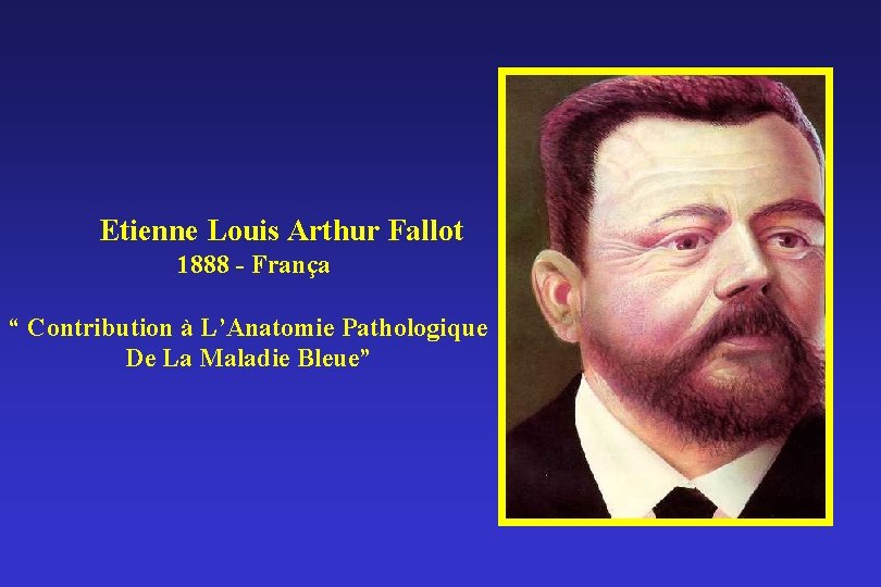 Etienne Louis Arthur Fallot 1888 - França “ Contribution à L’Anatomie Pathologique De La