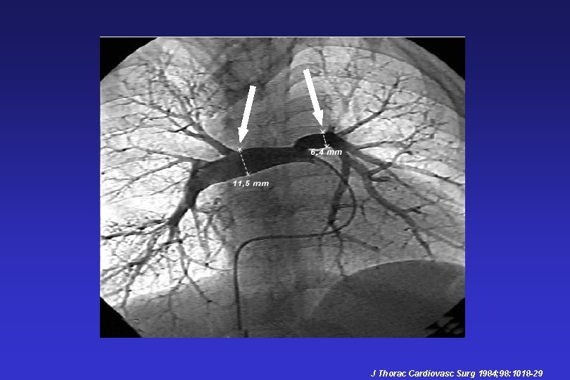 J Thorac Cardiovasc Surg 1984; 98: 1018 -29 