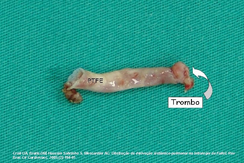 Croti UA, Braile DM, Hassem Sobrinho S, Moscardini AC. Obstrução de derivação sistêmico-pulmonar na