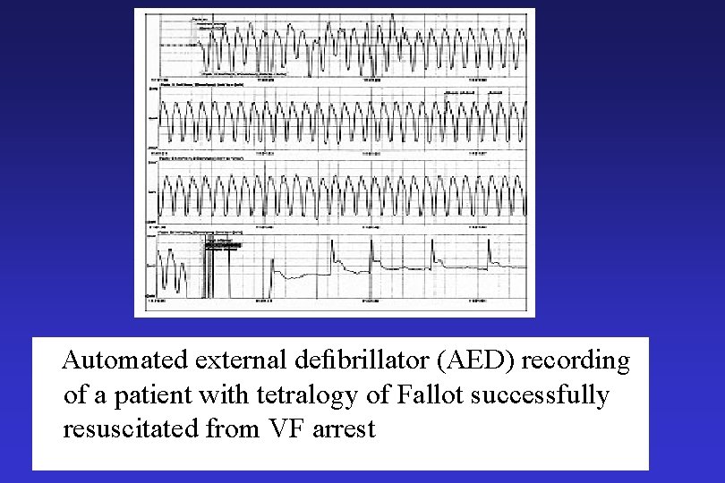  Automated external deﬁbrillator (AED) recording of a patient with tetralogy of Fallot successfully