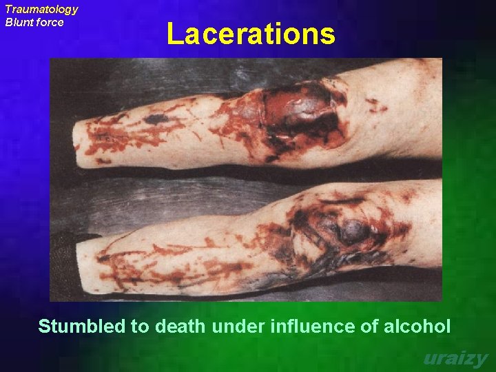 Traumatology Blunt force Lacerations Stumbled to death under influence of alcohol uraizy 