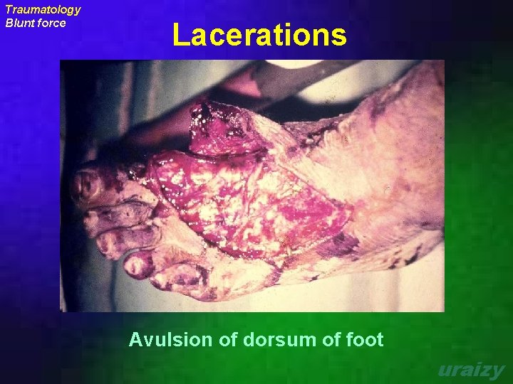 Traumatology Blunt force Lacerations Avulsion of dorsum of foot uraizy 