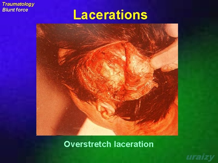 Traumatology Blunt force Lacerations Overstretch laceration uraizy 