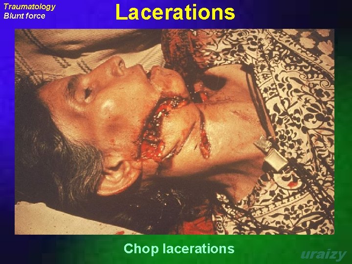 Traumatology Blunt force Lacerations Chop lacerations uraizy 