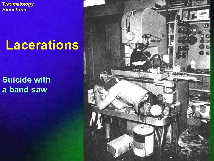 Traumatology Blunt force Lacerations Suicide with a band saw uraizy 