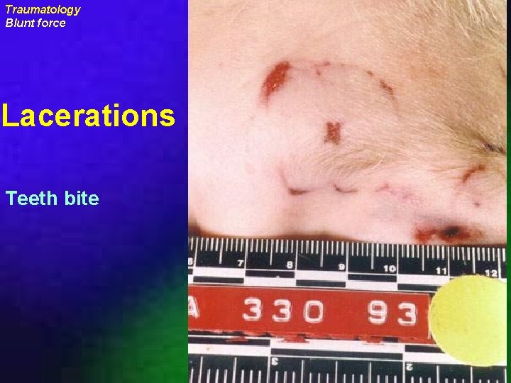 Traumatology Blunt force Lacerations Teeth bite uraizy 