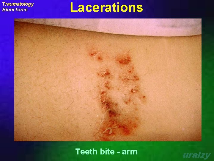 Traumatology Blunt force Lacerations Teeth bite - arm uraizy 
