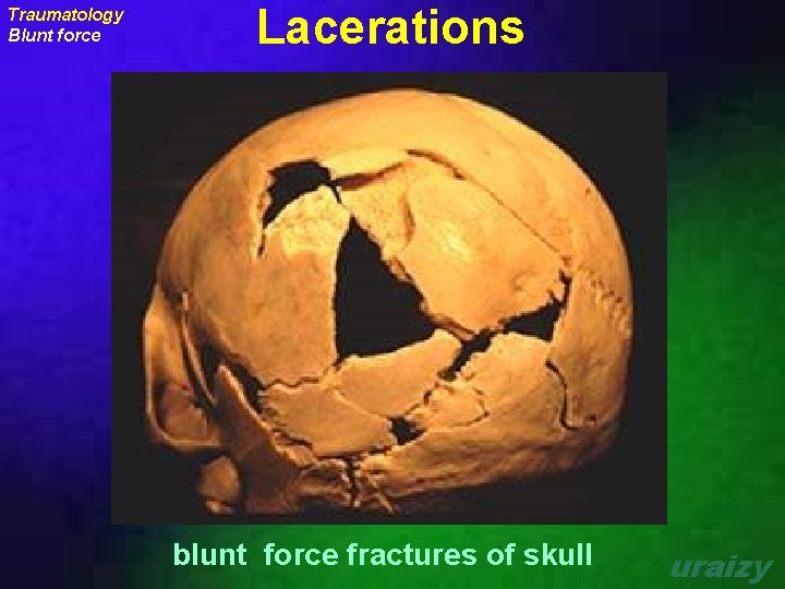 Traumatology Blunt force Lacerations blunt force fractures of skull uraizy 