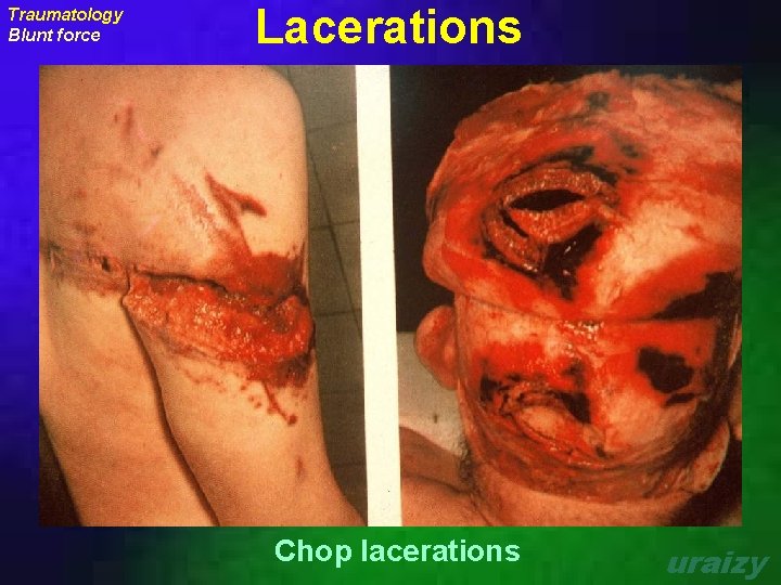 Traumatology Blunt force Lacerations Chop lacerations uraizy 