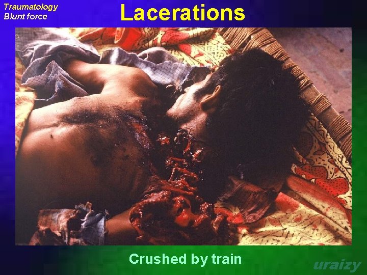 Traumatology Blunt force Lacerations Crushed by train uraizy 