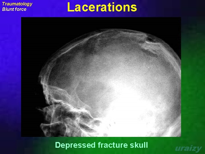 Traumatology Blunt force Lacerations Depressed fracture skull uraizy 