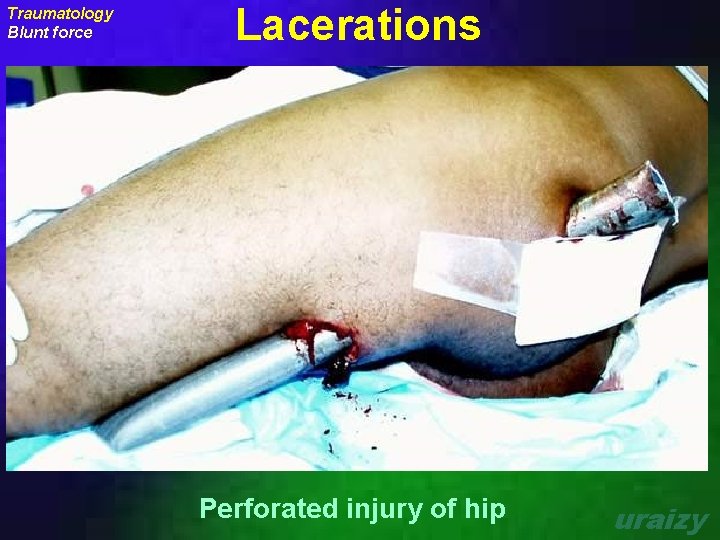 Traumatology Blunt force Lacerations Perforated injury of hip uraizy 
