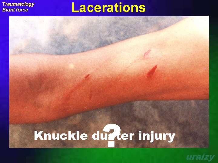 Traumatology Blunt force Lacerations ? Knuckle duster injury uraizy 