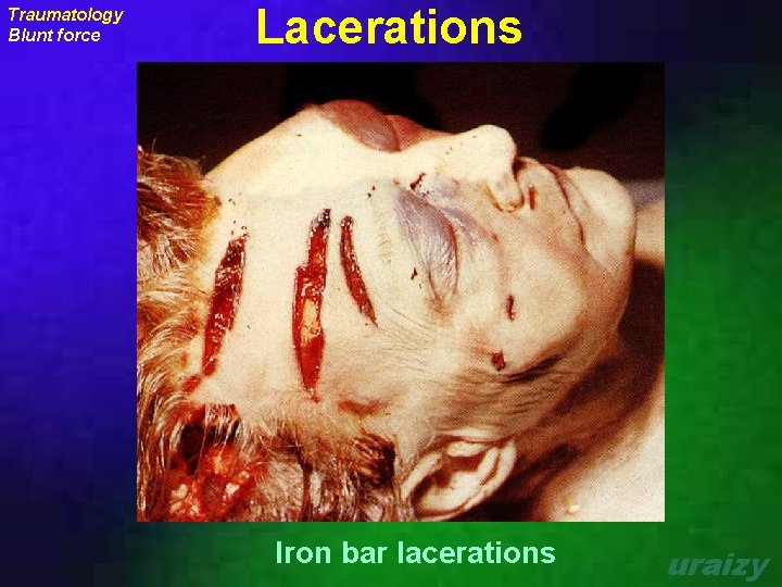 Traumatology Blunt force Lacerations Iron bar lacerations uraizy 