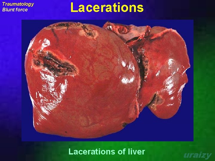 Traumatology Blunt force Lacerations of liver uraizy 