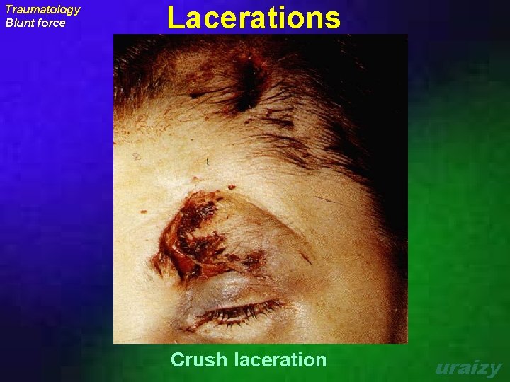 Traumatology Blunt force Lacerations Crush laceration uraizy 