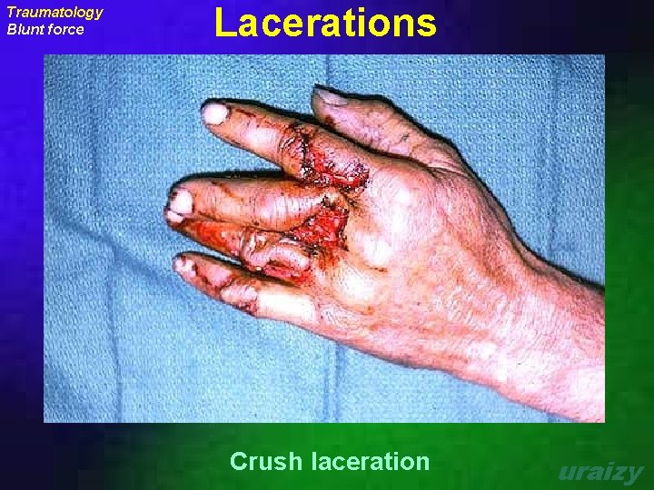 Traumatology Blunt force Lacerations Crush laceration uraizy 