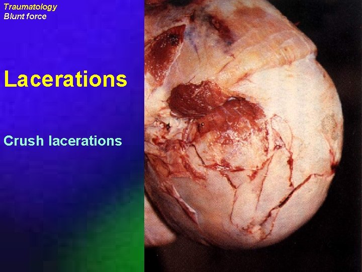 Traumatology Blunt force Lacerations Crush lacerations uraizy 
