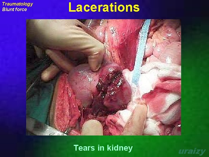Traumatology Blunt force Lacerations Tears in kidney uraizy 