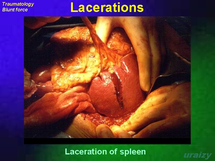 Traumatology Blunt force Lacerations Laceration of spleen uraizy 