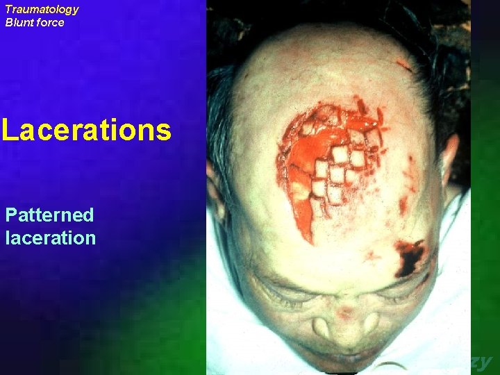 Traumatology Blunt force Lacerations Patterned laceration uraizy 