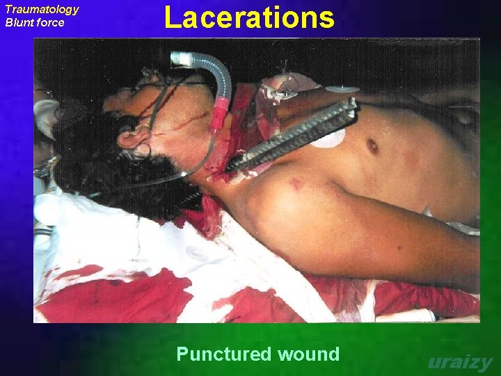Traumatology Blunt force Lacerations Punctured wound uraizy 