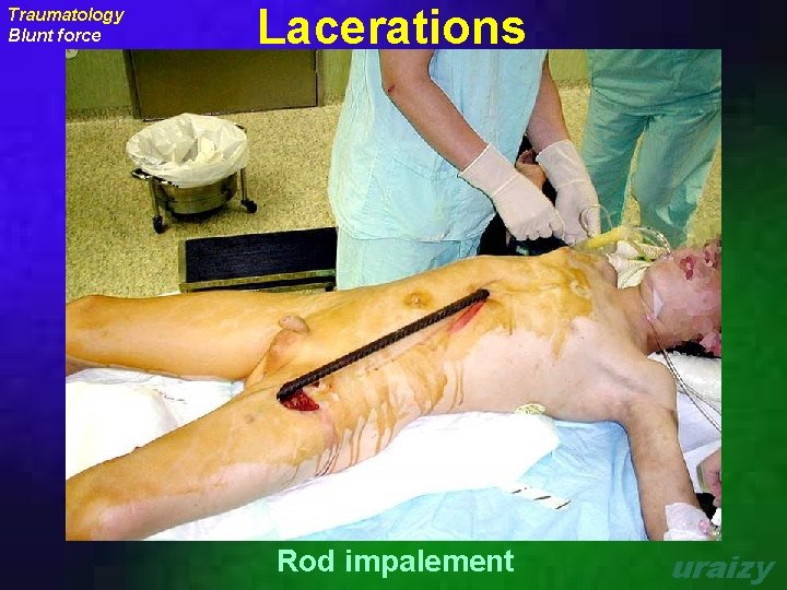 Traumatology Blunt force Lacerations Rod impalement uraizy 