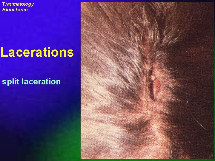 Traumatology Blunt force Lacerations split laceration uraizy 