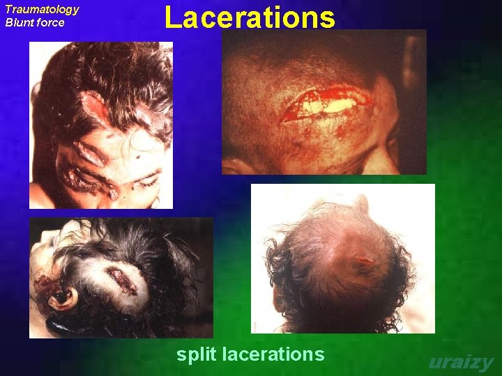 Traumatology Blunt force Lacerations split lacerations uraizy 