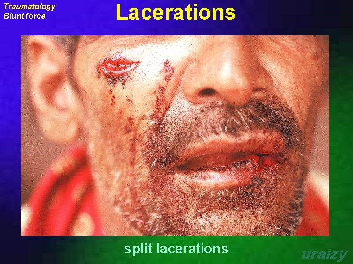 Traumatology Blunt force Lacerations split lacerations uraizy 