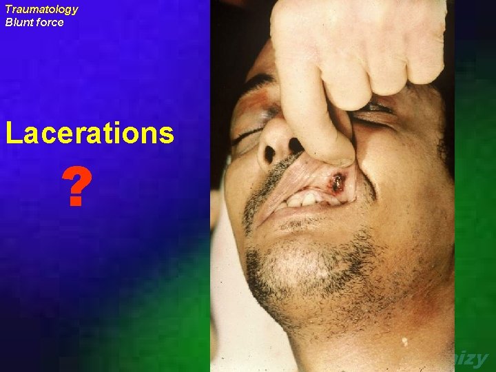 Traumatology Blunt force Lacerations ? uraizy 