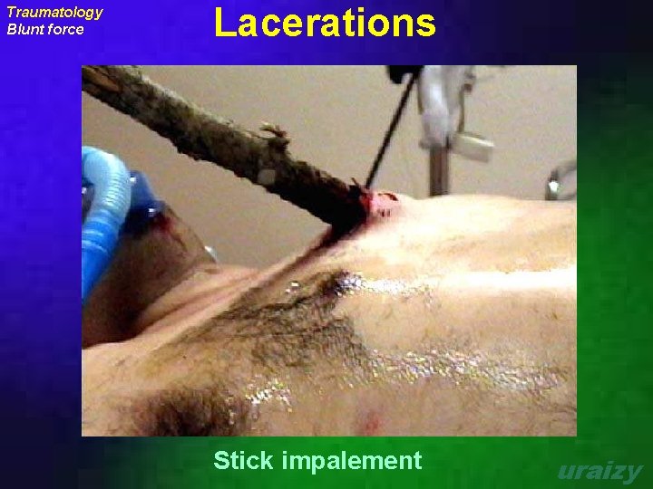Traumatology Blunt force Lacerations Stick impalement uraizy 