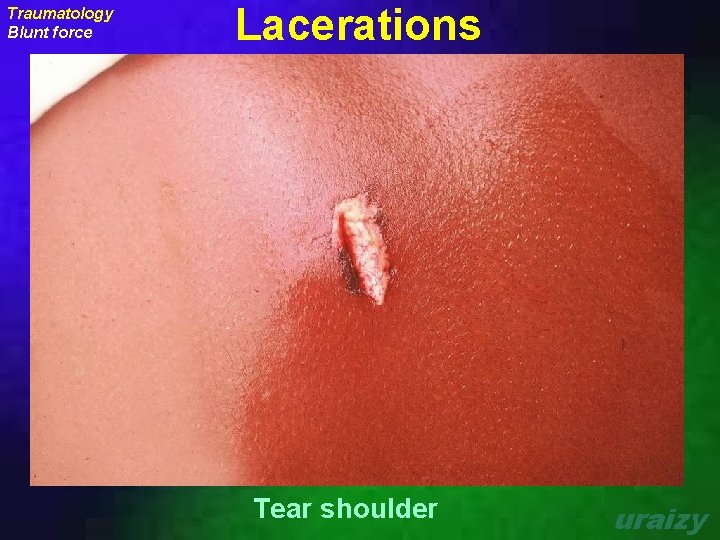 Traumatology Blunt force Lacerations Tear shoulder uraizy 