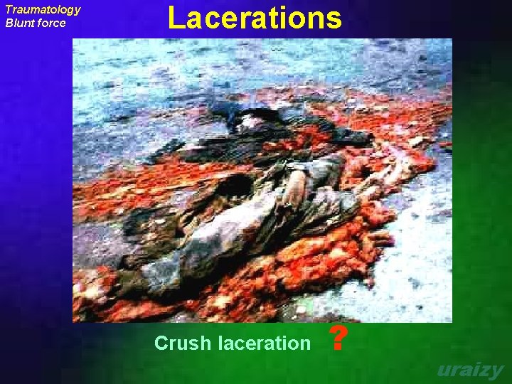 Traumatology Blunt force Lacerations Crush laceration ? uraizy 