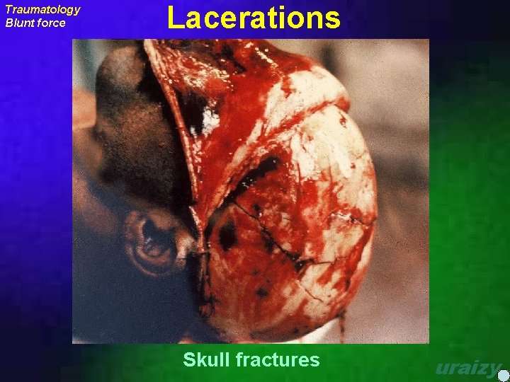 Traumatology Blunt force Lacerations Skull fractures uraizy 
