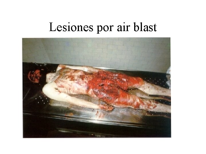 Lesiones por air blast 