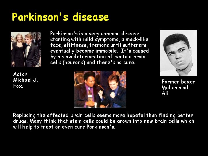 Parkinson's disease Parkinson's is a very common disease starting with mild symptoms, a mask-like