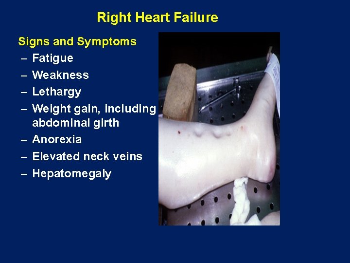 Right Heart Failure Signs and Symptoms – Fatigue – Weakness – Lethargy – Weight